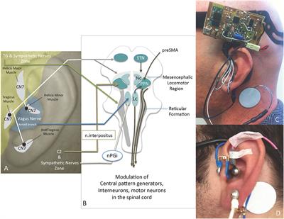 Rapid Alleviation of Parkinson’s Disease Symptoms via Electrostimulation of Intrinsic Auricular Muscle Zones